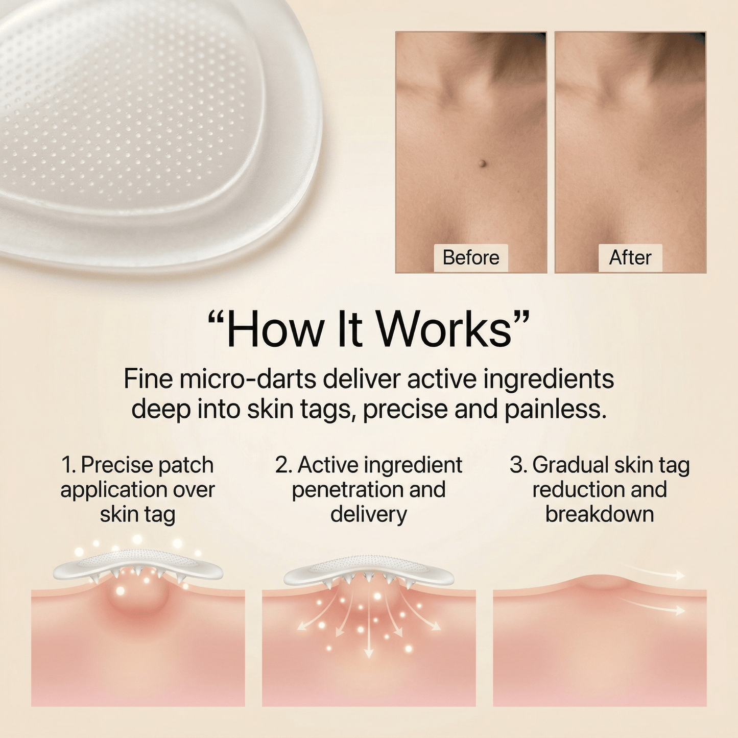 DermaSmooth - Tag & Mole Remover (Buy 1 Get 1 Free)